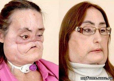 Операция на лицо
