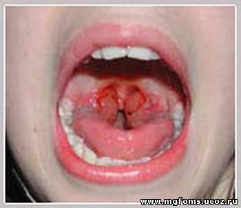 Абсцесс полости рта