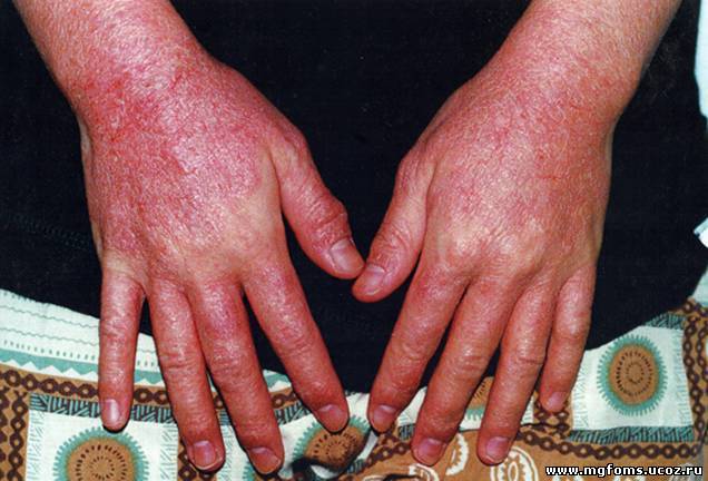 Аллергические дерматиты